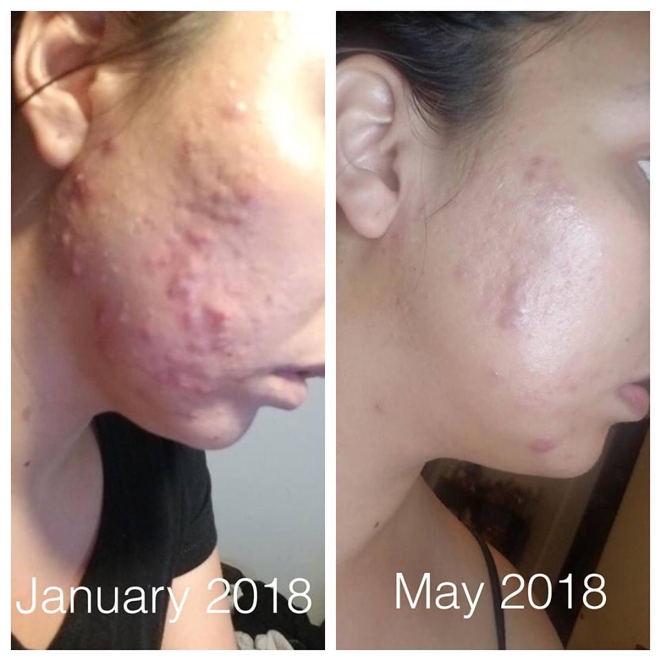 Super  Organic Acne Treatment