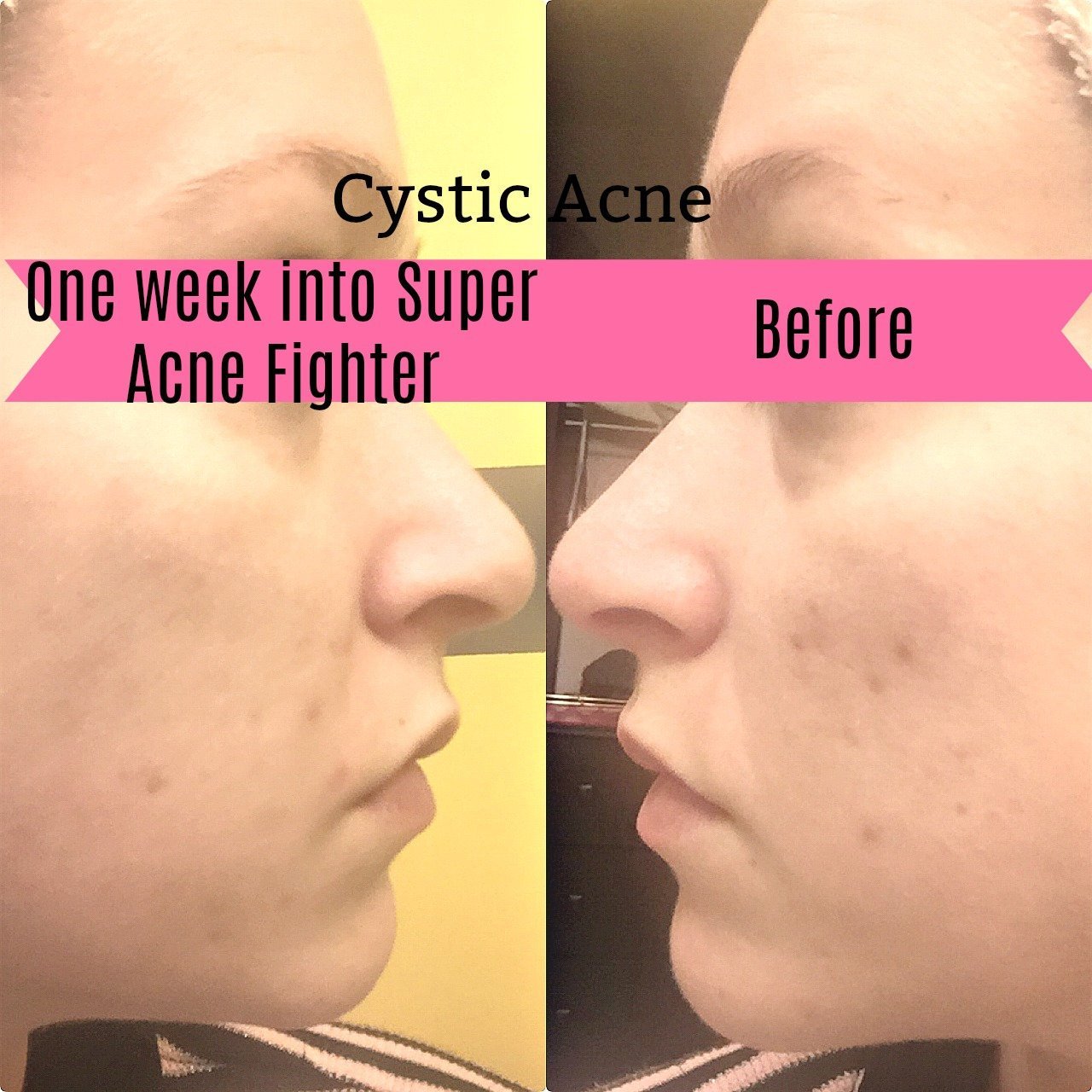 Super  Organic Acne Treatment