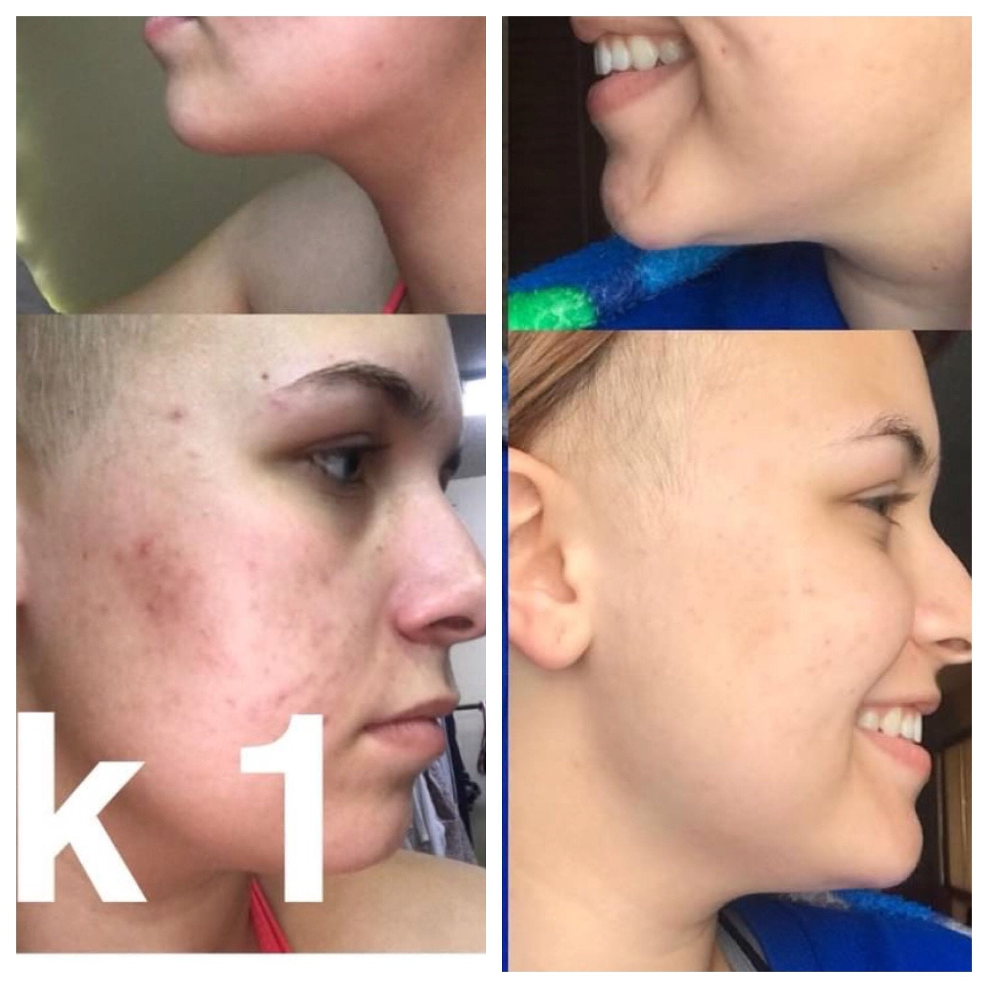 Super  Organic Acne Treatment